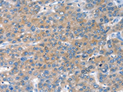 The image on the left is immunohistochemistry of paraffin-embedded Human liver cancer tissue using CSB-PA634200(CHAC1 Antibody) at dilution 1/40, on the right is treated with fusion protein. (Original magnification: ×200)