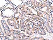 The image on the left is immunohistochemistry of paraffin-embedded Human thyroid cancer tissue using CSB-PA634270(ADRBK1 Antibody) at dilution 1/87, on the right is treated with synthetic peptide. (Original magnification: ×200)