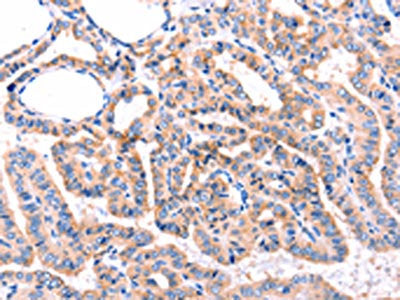The image on the left is immunohistochemistry of paraffin-embedded Human thyroid cancer tissue using CSB-PA634270(ADRBK1 Antibody) at dilution 1/87, on the right is treated with synthetic peptide. (Original magnification: ×200)