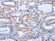 The image on the left is immunohistochemistry of paraffin-embedded Human thyroid cancer tissue using CSB-PA634274(GFER Antibody) at dilution 1/50, on the right is treated with fusion protein. (Original magnification: ×200)