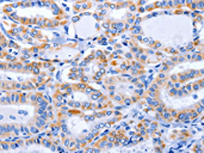 The image on the left is immunohistochemistry of paraffin-embedded Human thyroid cancer tissue using CSB-PA634274(GFER Antibody) at dilution 1/50, on the right is treated with fusion protein. (Original magnification: ×200)