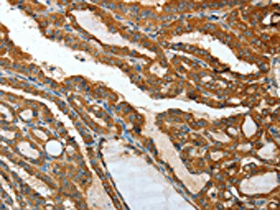 The image on the left is immunohistochemistry of paraffin-embedded Human thyroid cancer tissue using CSB-PA634409(IL12RB1 Antibody) at dilution 1/15, on the right is treated with fusion protein. (Original magnification: ×200)