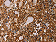 The image on the left is immunohistochemistry of paraffin-embedded Human thyroid cancer tissue using CSB-PA636707(IHH Antibody) at dilution 1/50, on the right is treated with fusion protein. (Original magnification: ×200)