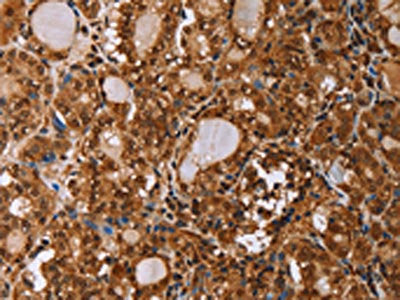 The image on the left is immunohistochemistry of paraffin-embedded Human thyroid cancer tissue using CSB-PA636707(IHH Antibody) at dilution 1/50, on the right is treated with fusion protein. (Original magnification: ×200)