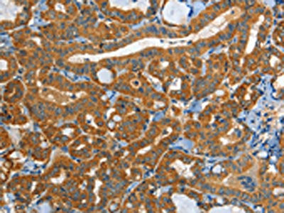 The image on the left is immunohistochemistry of paraffin-embedded Human thyroid cancer tissue using CSB-PA637350(EPHB3 Antibody) at dilution 1/40, on the right is treated with synthetic peptide. (Original magnification: ×200)