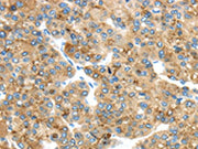 The image on the left is immunohistochemistry of paraffin-embedded Human liver cancer tissue using CSB-PA639635(TMED4 Antibody) at dilution 1/45, on the right is treated with fusion protein. (Original magnification: ×200)