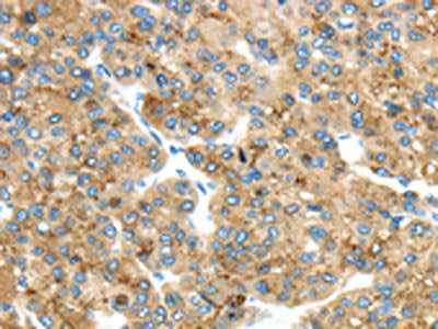 The image on the left is immunohistochemistry of paraffin-embedded Human liver cancer tissue using CSB-PA639635(TMED4 Antibody) at dilution 1/45, on the right is treated with fusion protein. (Original magnification: ×200)