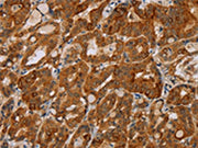The image on the left is immunohistochemistry of paraffin-embedded Human thyroid cancer tissue using CSB-PA639973(MTUS1 Antibody) at dilution 1/40, on the right is treated with fusion protein. (Original magnification: ×200)