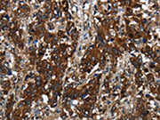 The image on the left is immunohistochemistry of paraffin-embedded Human liver cancer tissue using CSB-PA640140(GLIPR1 Antibody) at dilution 1/60, on the right is treated with fusion protein. (Original magnification: ×200)
