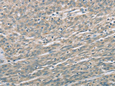 The image on the left is immunohistochemistry of paraffin-embedded Human esophagus cancer tissue using CSB-PA640379(EDA2R Antibody) at dilution 1/60, on the right is treated with fusion protein. (Original magnification: ×200)