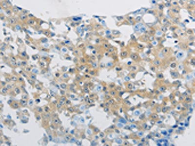 The image on the left is immunohistochemistry of paraffin-embedded Human breast cancer tissue using CSB-PA640573(CLEC4C Antibody) at dilution 1/70, on the right is treated with synthetic peptide. (Original magnification: ×200)