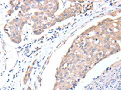 The image on the left is immunohistochemistry of paraffin-embedded Human breast cancer tissue using CSB-PA641289(ACTL8 Antibody) at dilution 1/15, on the right is treated with fusion protein. (Original magnification: ×200)