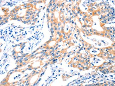 The image on the left is immunohistochemistry of paraffin-embedded Human gastic cancer tissue using CSB-PA641987(HTR3B Antibody) at dilution 1/30, on the right is treated with synthetic peptide. (Original magnification: ×200)