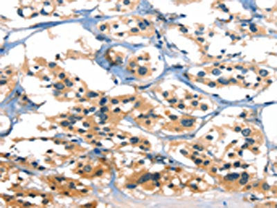 The image on the left is immunohistochemistry of paraffin-embedded Human thyroid cancer tissue using CSB-PA642427(A4GALT Antibody) at dilution 1/30, on the right is treated with synthetic peptide. (Original magnification: ×200)