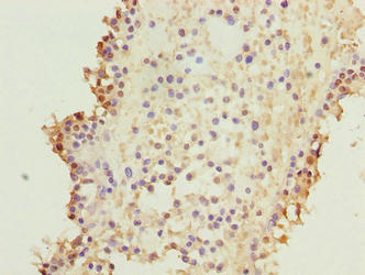 Immunohistochemistry of paraffin-embedded human breast cancer using CSB-PA642548LA01HU at dilution of 1:100