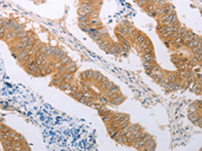 The image on the left is immunohistochemistry of paraffin-embedded Human colon cancer tissue using CSB-PA642637(PDK4 Antibody) at dilution 1/50, on the right is treated with synthetic peptide. (Original magnification: ×200)