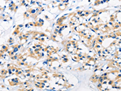 The image on the left is immunohistochemistry of paraffin-embedded Human thyroid cancer tissue using CSB-PA643791(HK1 Antibody) at dilution 1/50, on the right is treated with fusion protein. (Original magnification: ×200)