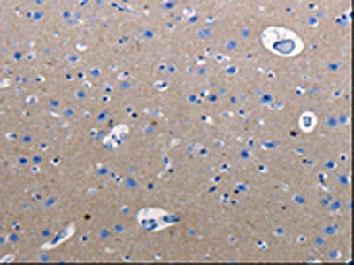 The image on the left is immunohistochemistry of paraffin-embedded Human cervical cancer tissue using CSB-PA643796(RAB3c Antibody) at dilution 1/25, on the right is treated with synthetic peptide. (Original magnification: ×200)