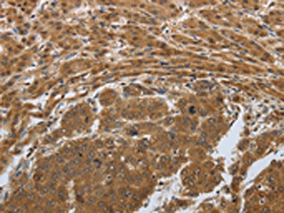 The image on the left is immunohistochemistry of paraffin-embedded Human liver cancer tissue using CSB-PA643972(PSMD6 Antibody) at dilution 1/50, on the right is treated with synthetic peptide. (Original magnification: ×200)