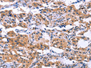 The image on the left is immunohistochemistry of paraffin-embedded Human thyroid cancer tissue using CSB-PA644588(ESPL1 Antibody) at dilution 1/40, on the right is treated with synthetic peptide. (Original magnification: ×200)