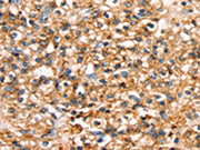 The image on the left is immunohistochemistry of paraffin-embedded Human prostate cancer tissue using CSB-PA644639(SLC34A3 Antibody) at dilution 1/20, on the right is treated with synthetic peptide. (Original magnification: ×200)