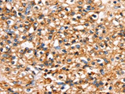 The image on the left is immunohistochemistry of paraffin-embedded Human prostate cancer tissue using CSB-PA644639(SLC34A3 Antibody) at dilution 1/20, on the right is treated with synthetic peptide. (Original magnification: ×200)