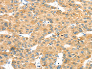 The image on the left is immunohistochemistry of paraffin-embedded Human liver cancer tissue using CSB-PA644665(MAPK12 Antibody) at dilution 1/25, on the right is treated with fusion protein. (Original magnification: ×200)