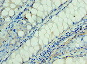 Immunohistochemistry of paraffin-embedded human colon cancer using CSB-PA644834DSR1HU at dilution of 1:100
