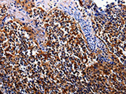 The image on the left is immunohistochemistry of paraffin-embedded Human tosil tissue using CSB-PA645798(IL17RC Antibody) at dilution 1/30, on the right is treated with fusion protein. (Original magnification: ×200)