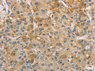 The image on the left is immunohistochemistry of paraffin-embedded Human liver cancer tissue using CSB-PA646140(CENPF Antibody) at dilution 1/40, on the right is treated with synthetic peptide. (Original magnification: ×200)