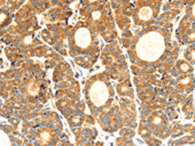 The image on the left is immunohistochemistry of paraffin-embedded Human thyroid cancer tissue using CSB-PA646965(CYP7A1 Antibody) at dilution 1/30, on the right is treated with synthetic peptide. (Original magnification: X200)