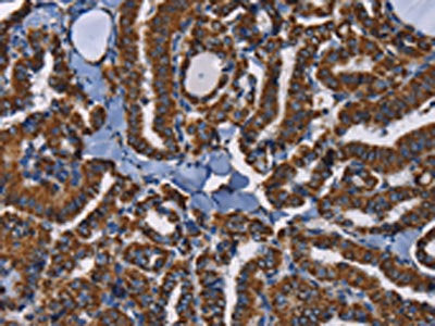 The image on the left is immunohistochemistry of paraffin-embedded Human thyroid cancer tissue using CSB-PA648744(ADRBK2 Antibody) at dilution 1/40, on the right is treated with fusion protein. (Original magnification: ×200)