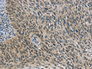 The image on the left is immunohistochemistry of paraffin-embedded Human cervical cancer tissue using CSB-PA652205(FOXF1 Antibody) at dilution 1/25, on the right is treated with synthetic peptide. (Original magnification: ×200)