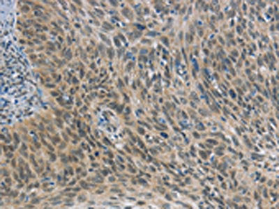 The image on the left is immunohistochemistry of paraffin-embedded Human cervical cancer tissue using CSB-PA652205(FOXF1 Antibody) at dilution 1/25, on the right is treated with synthetic peptide. (Original magnification: ×200)