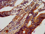 IHC image of CSB-PA652403LA01HU diluted at 1:600 and staining in paraffin-embedded human colon cancer performed on a Leica BondTM system. After dewaxing and hydration, antigen retrieval was mediated by high pressure in a citrate buffer (pH 6.0). S...