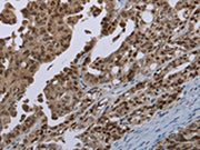The image on the left is immunohistochemistry of paraffin-embedded Human ovarian cancer tissue using CSB-PA652649(MAGEB18 Antibody) at dilution 1/20, on the right is treated with synthetic peptide. (Original magnification: ×200)