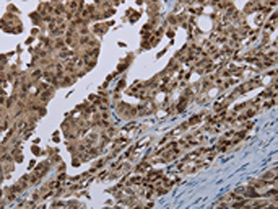 The image on the left is immunohistochemistry of paraffin-embedded Human ovarian cancer tissue using CSB-PA652649(MAGEB18 Antibody) at dilution 1/20, on the right is treated with synthetic peptide. (Original magnification: ×200)