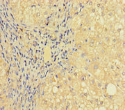Immunohistochemistry of paraffin-embedded human liver cancer using CSB-PA652689LA01HU at dilution of 1:100