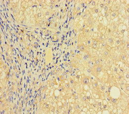 Immunohistochemistry of paraffin-embedded human liver cancer using CSB-PA652689LA01HU at dilution of 1:100