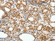 The image on the left is immunohistochemistry of paraffin-embedded Human thyroid cancer tissue using CSB-PA653643(PDCD6 Antibody) at dilution 1/30, on the right is treated with fusion protein. (Original magnification: ×200)