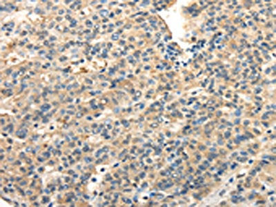 The image on the left is immunohistochemistry of paraffin-embedded Human liver cancer tissue using CSB-PA654024(TWIST2 Antibody) at dilution 1/20, on the right is treated with fusion protein. (Original magnification: ×200)