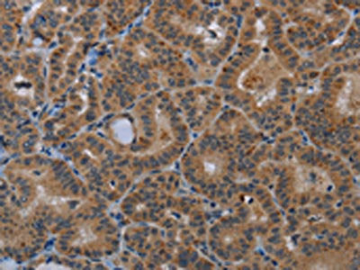 The image on the left is immunohistochemistry of paraffin-embedded Human thyroid cancer tissue using CSB-PA654250(SLC22A2 Antibody) at dilution 1/20, on the right is treated with synthetic peptide. (Original magnification: ×200)