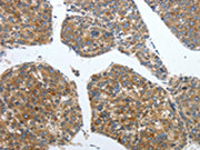 The image on the left is immunohistochemistry of paraffin-embedded Human liver cancer tissue using CSB-PA656448(PDK2 Antibody) at dilution 1/40, on the right is treated with synthetic peptide. (Original magnification: ×200)