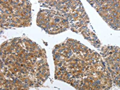 The image on the left is immunohistochemistry of paraffin-embedded Human liver cancer tissue using CSB-PA656448(PDK2 Antibody) at dilution 1/40, on the right is treated with synthetic peptide. (Original magnification: ×200)