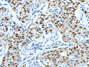 The image on the left is immunohistochemistry of paraffin-embedded Human lung cancer tissue using CSB-PA656958(JUN Antibody) at dilution 1/30, on the right is treated with fusion protein. (Original magnification: ×200)