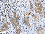The image on the left is immunohistochemistry of paraffin-embedded Human cervical cancer tissue using CSB-PA657435(DSTYK Antibody) at dilution 1/40, on the right is treated with fusion protein. (Original magnification: ×200)