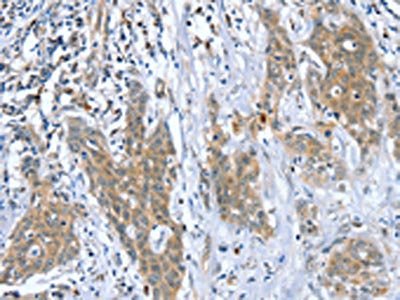 The image on the left is immunohistochemistry of paraffin-embedded Human cervical cancer tissue using CSB-PA657435(DSTYK Antibody) at dilution 1/40, on the right is treated with fusion protein. (Original magnification: ×200)