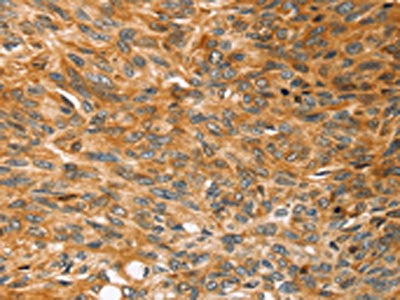The image on the left is immunohistochemistry of paraffin-embedded Human esophagus cancer tissue using CSB-PA657438(SOX11 Antibody) at dilution 1/20, on the right is treated with synthetic peptide. (Original magnification: ×200)