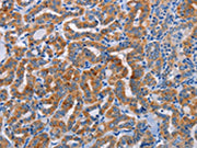 The image on the left is immunohistochemistry of paraffin-embedded Human thyroid cancer tissue using CSB-PA657688(ALG12 Antibody) at dilution 1/20, on the right is treated with fusion protein. (Original magnification: ×200)