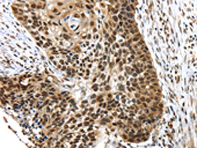 The image on the left is immunohistochemistry of paraffin-embedded Human esophagus cancer tissue using CSB-PA657723(TEX37 Antibody) at dilution 1/40, on the right is treated with synthetic peptide. (Original magnification: ×200)
